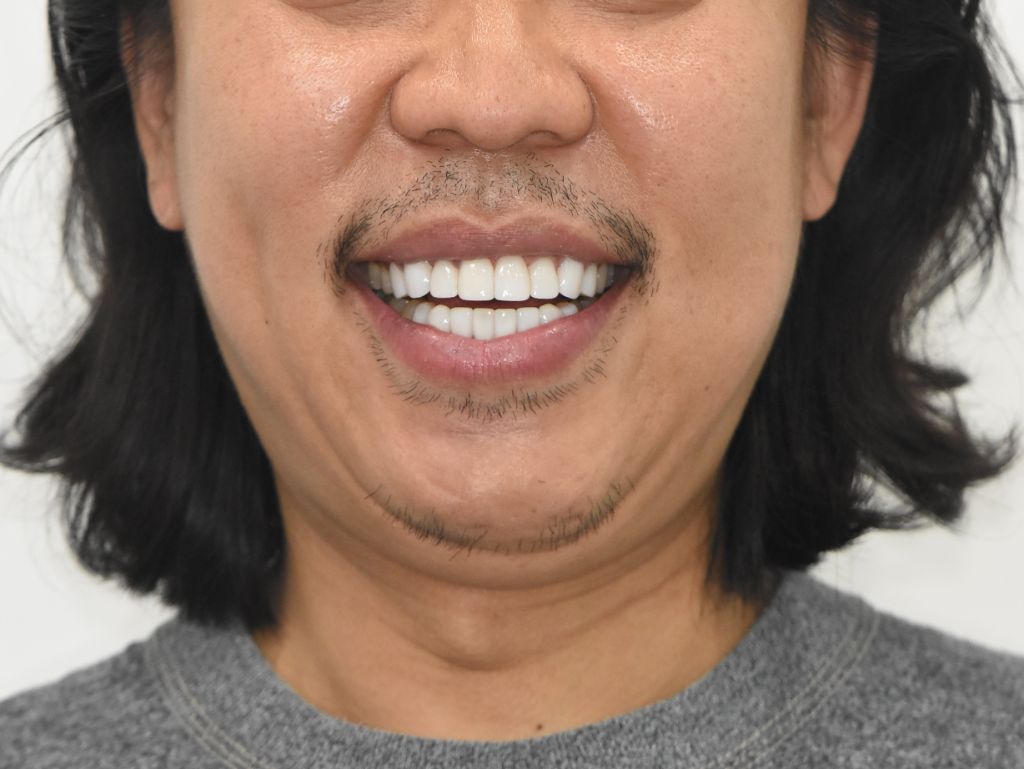 Case 02 — after treatment