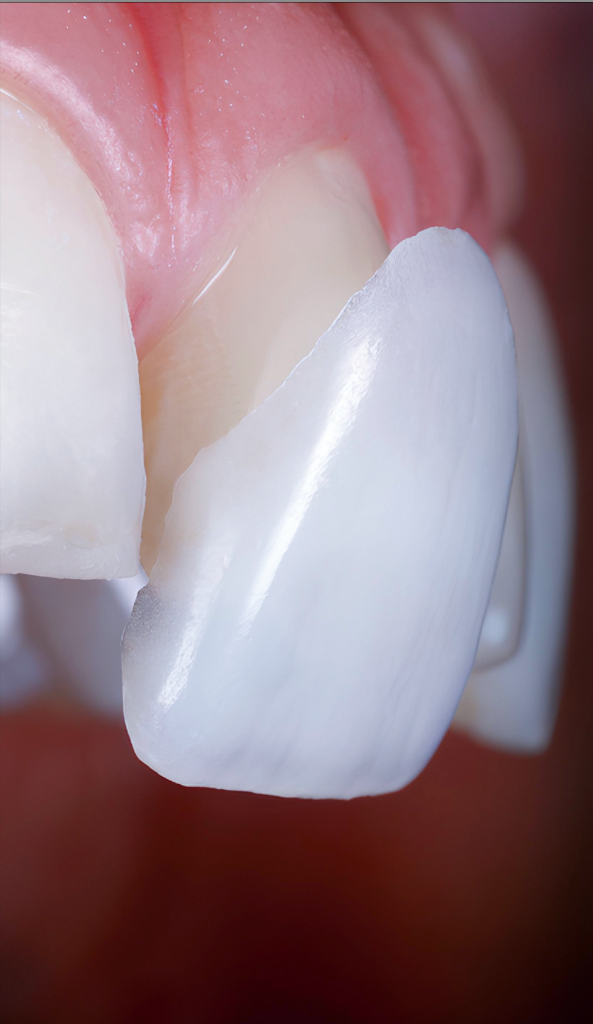 Harmony — veneer harmonizing with the natural tooth